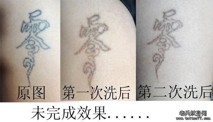 武汉专业激光洗纹身介绍黑色文字洗纹身效果案