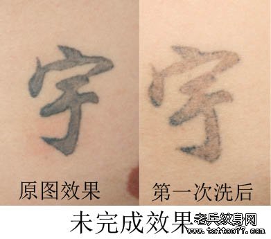 最好最专业的胸口黑色汉字激光洗纹身过程_武
