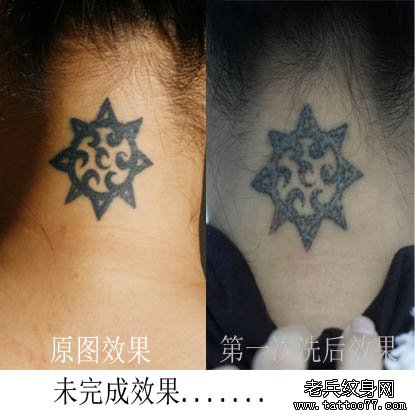 武汉专业激光洗纹身店--颈部黑色图腾洗纹身案