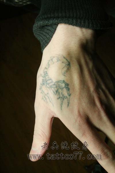 手部虎口黑色蝎子激光洗纹身过程_武汉纹身店