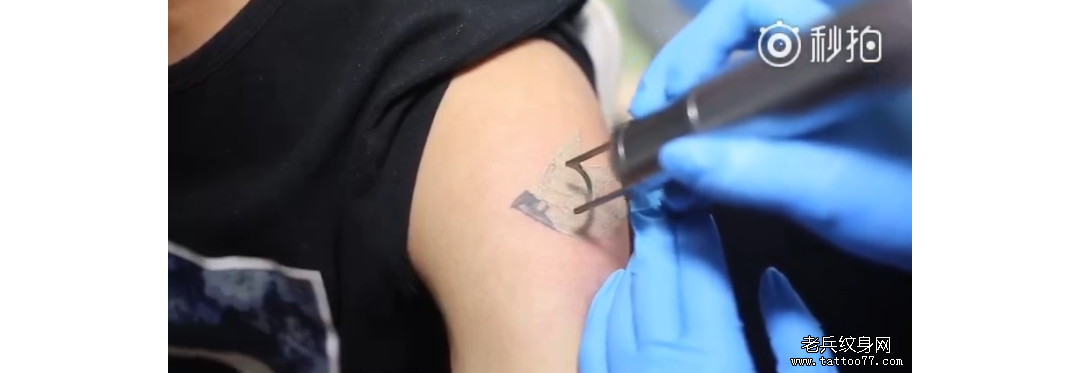 大臂燕子激光洗纹身视频