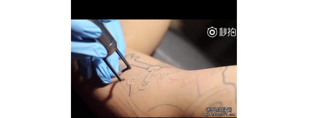 来处湖南的洗纹身顾客：十字架线条皮秒洗纹身过程