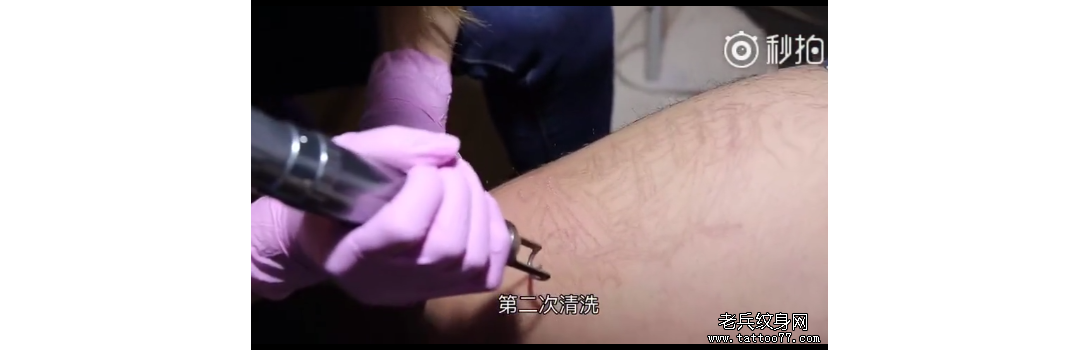 深圳洗纹身顾客：腿部帆船第二次皮秒洗纹身过程