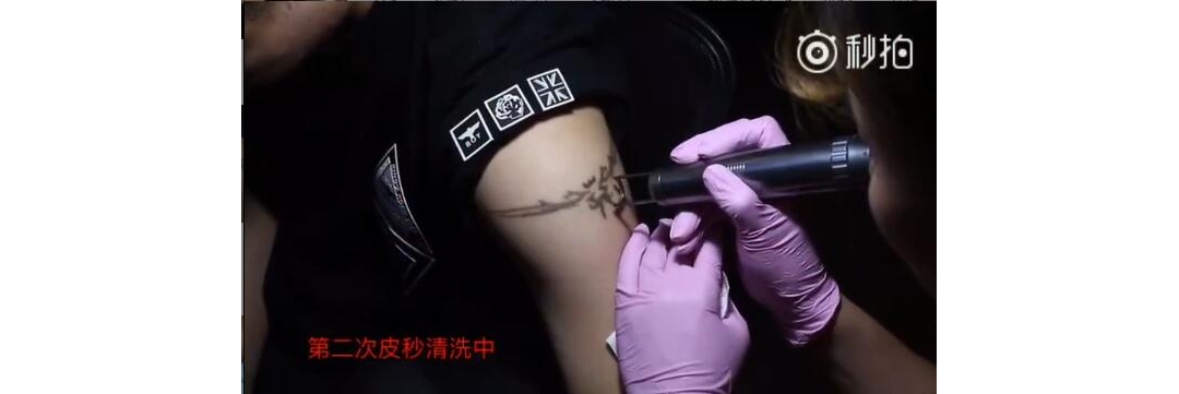 武汉皮秒激光洗纹身：手臂图腾黑色第二次皮秒洗纹身中