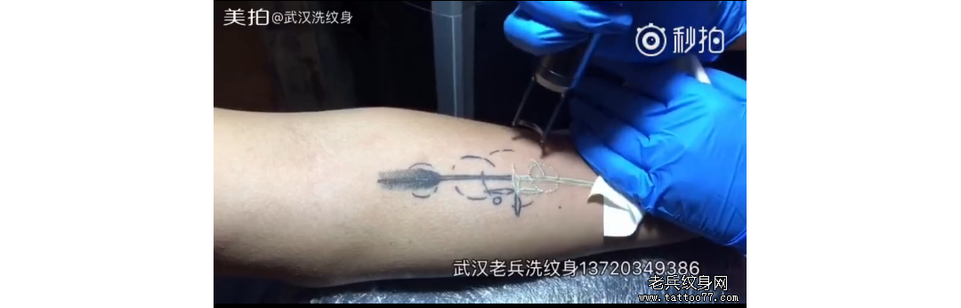 手部箭纹身激光皮秒洗纹身效果