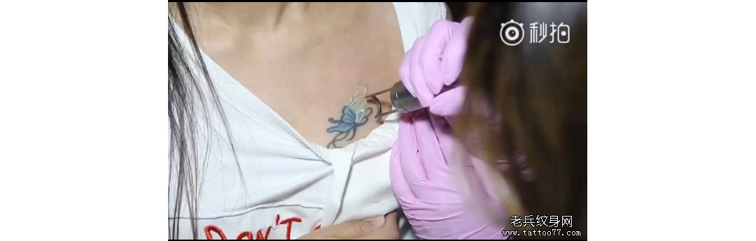 武汉专业皮秒激光洗纹身分享妹子胸口蝴蝶洗纹身案例