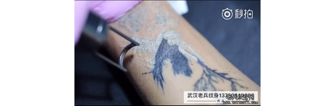 手部黑色皮秒洗纹身案例分享