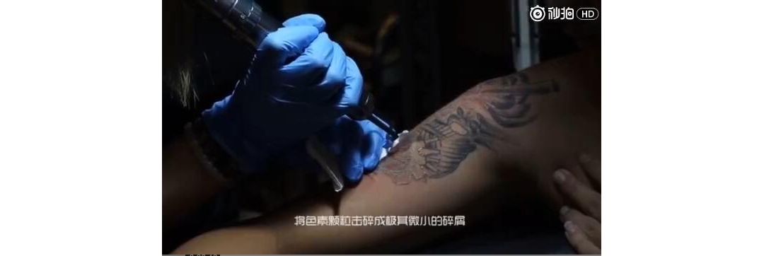 武汉最好的洗纹身店孙悟空黑色皮秒激光洗纹身案例过程