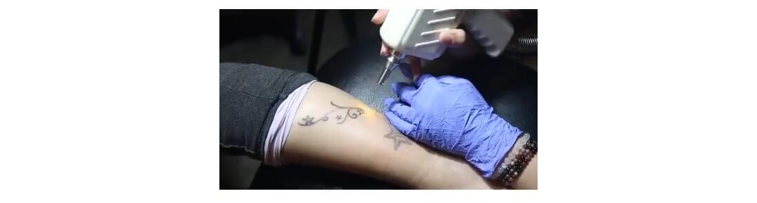 武汉专业皮秒洗纹身视频带你了解洗纹身效果过程