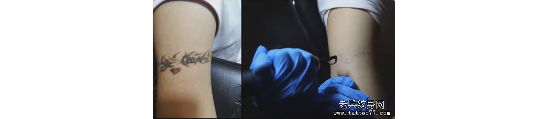武汉皮秒洗纹身 ——妹子手臂臂环纹身皮秒洗纹身过程