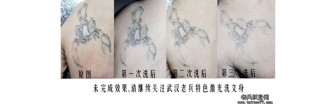 武汉特色激光洗纹身店介绍虎口蝎子黑色洗纹身案例