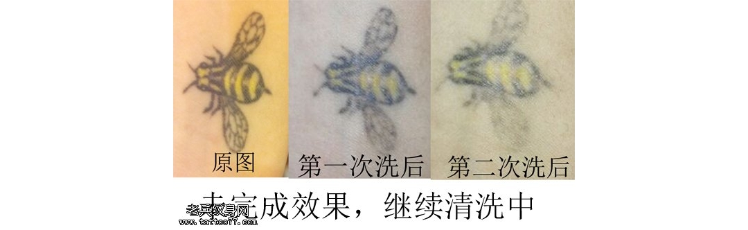 手腕蜜蜂黑色最好的皮秒激光洗纹身效果案例