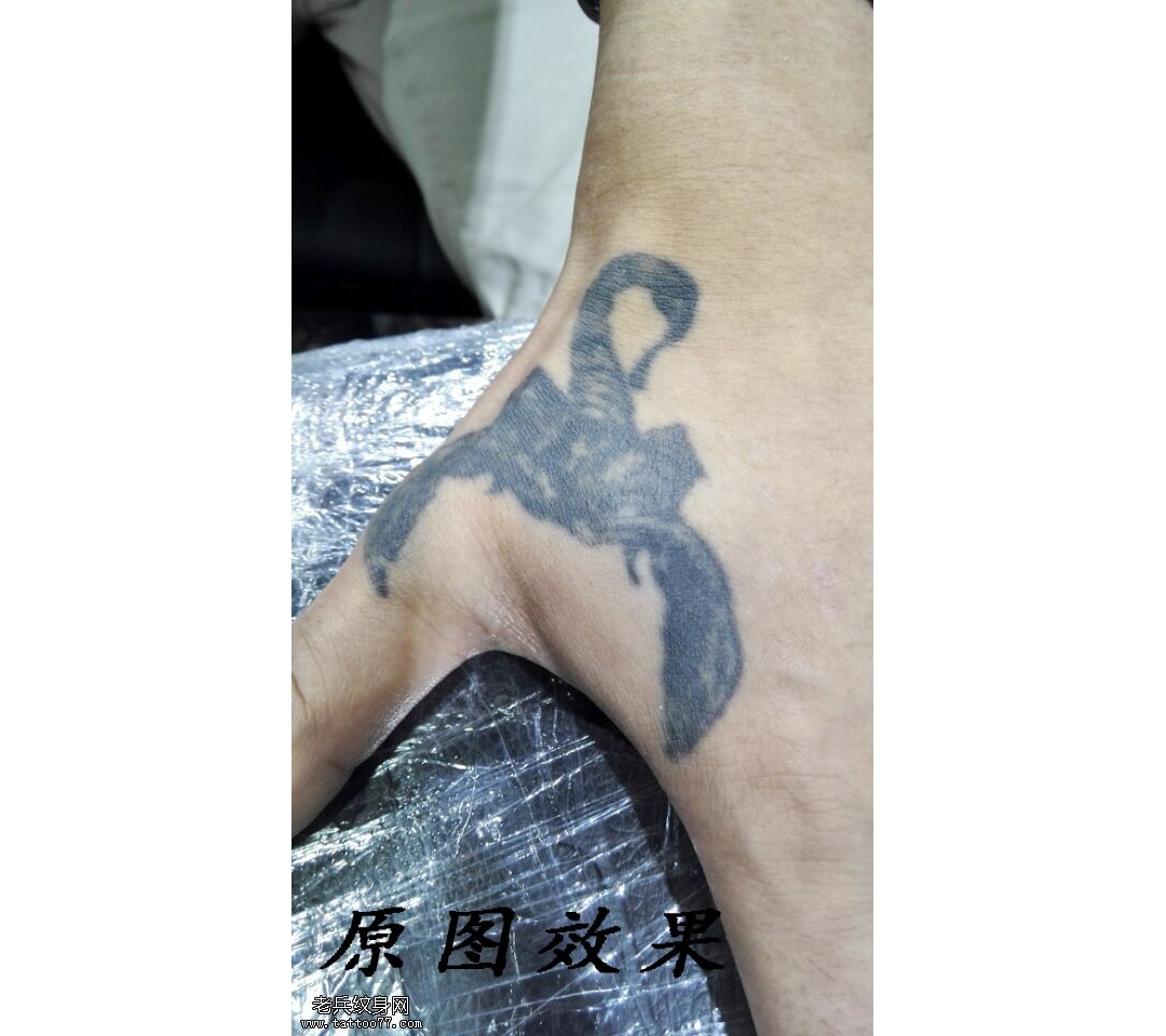 手部虎口蝎子黑色激光洗纹身案例
