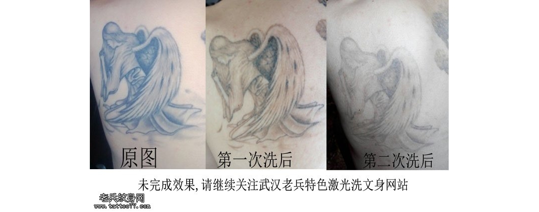 武汉最好的激光洗纹身店后背天使洗纹身效果案例