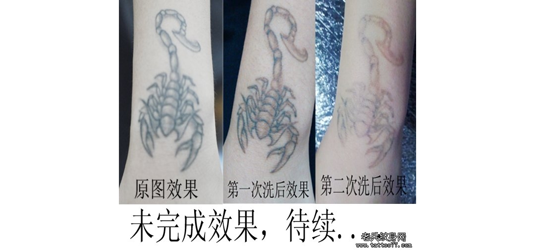 手部蝎子黑色皮秒特色洗纹身效果案例过程