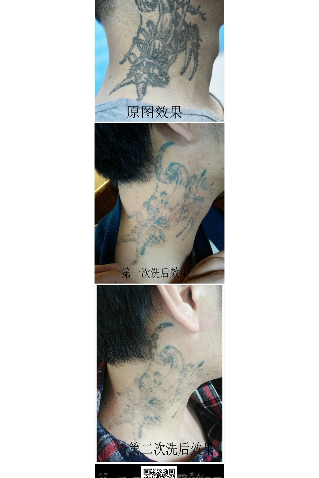 武汉洗纹身店推荐颈部黑色洗纹身效果对比