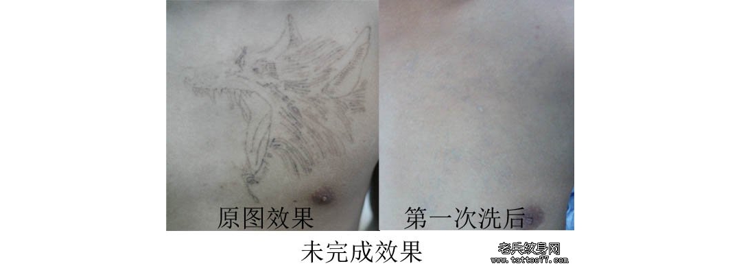 最有效最快速的纹身方法：胸口线条狼头激洗纹身案例