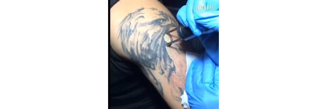 帅哥大臂老鹰专业皮秒洗纹身第一清洗效果案例