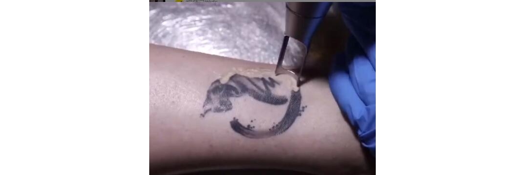 妹子脚踝猫咪纹身最好的皮秒洗纹身效果案例