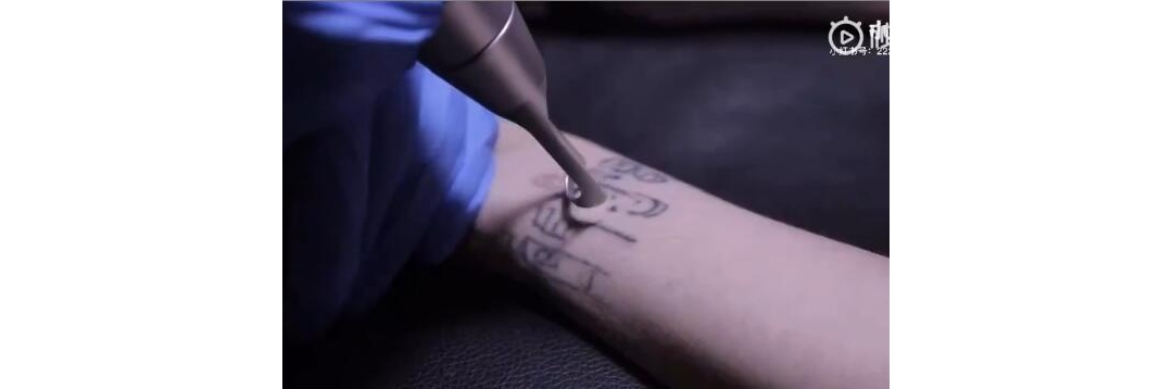 妹子手腕藏文纹身最好的皮秒洗纹身效果案例