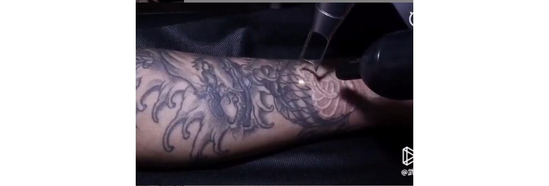 来自武当山的洗纹身顾客：手部龙皮秒洗纹身中
