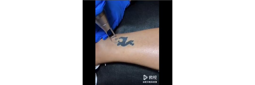 武汉洗纹身：脚踝图腾鹿皮秒洗纹身过程
