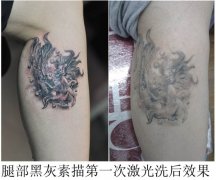 武汉激光洗纹身是怎样算价钱的？