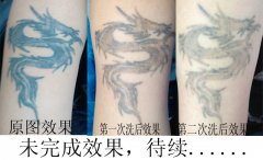 来自孝感洗纹身者想咨询洗一个黑色图腾纹身需要多少钱？