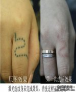 武汉老兵专业特色激光洗纹身设备有着哪些特色之处