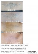 激光洗纹身最佳方法就是选择正规专业的洗纹身店