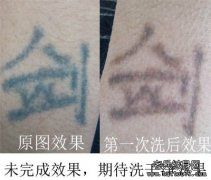 想当兵到哪家洗纹身店洗纹身最好？