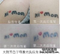 最好的激光洗纹身后要注意的四大护理方法