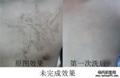 在武汉专业洗纹身店洗纹身留疤吗？