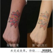 武汉激光洗纹身贵不贵？效果好吗？