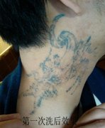 武汉洗纹身最安全的方法是哪种？