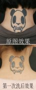 武汉哪里能洗纹身？