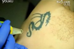 武汉老兵专业洗纹身带你了解什么的洗纹身不会留疤