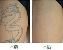 武汉洗纹身店告诉你最快洗纹身的方法