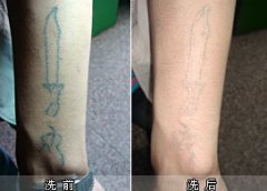 洗纹身疼吗？—武汉专业洗纹身店为你讲解