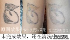 武汉快速洗纹身机构告诉你手术和激光洗纹身哪个好？