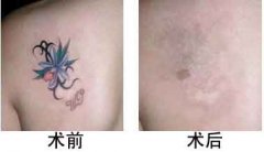 激光洗纹身别等到急需时再去洗！