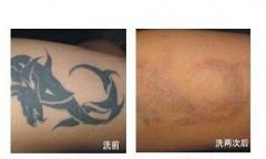 大家一定要慎重洗纹身