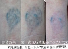 为大家讲解洗纹身激光好还是药水好