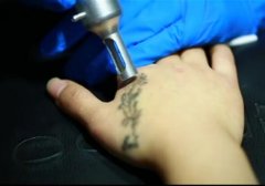 武汉洗纹身店：手部黑色激光洗纹身视频