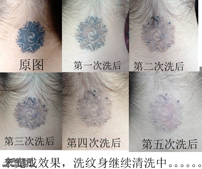 市场上一般激光纹身要多少钱