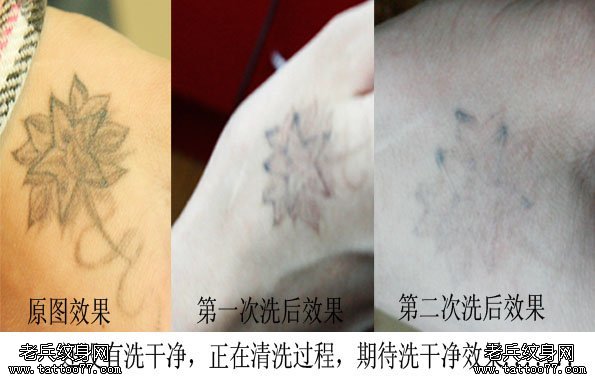 激光纹身要多少钱看你选择的店铺