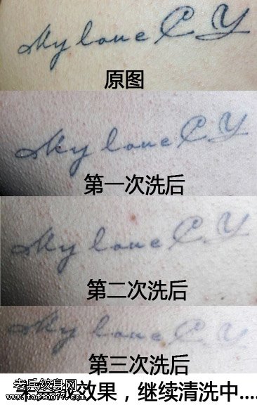 激光洗纹身要洗多少次才能和正常皮肤一样？