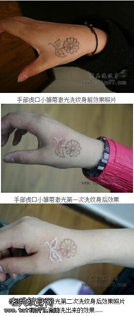 激光洗tattoo疼痛