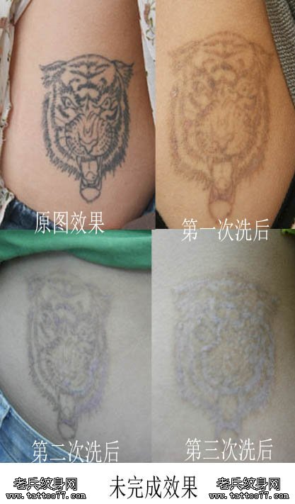 激光为什么可以完全洗干净纹身图案颜色？