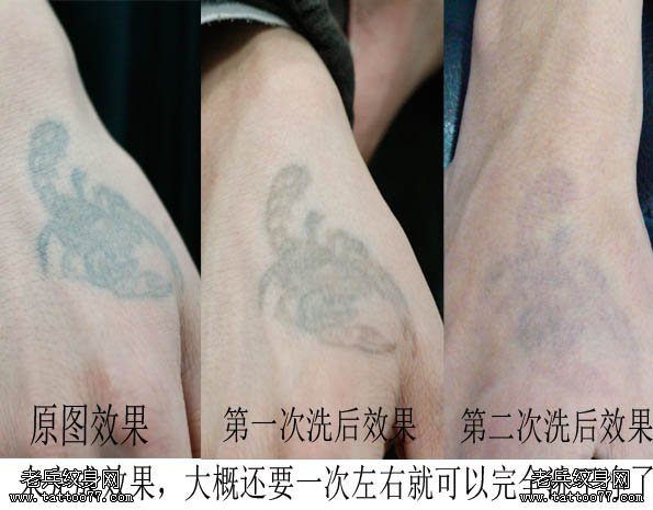 武汉特色激光洗tattoo为你介绍6种洗tattoo的方法及特点